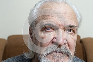 Eye disease in an old man photo